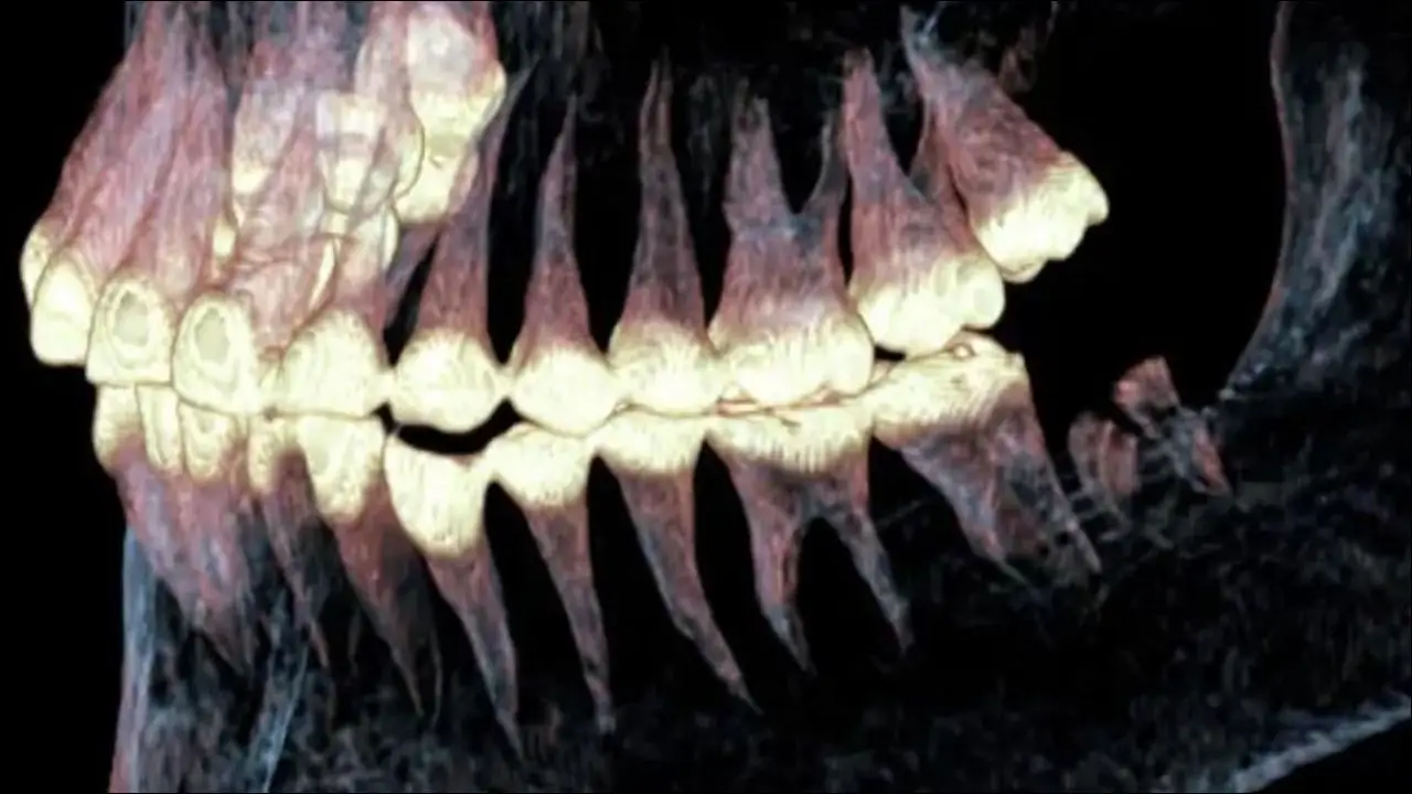 Momia De Siberia De 2.500 Años Muestra Evidencia De Una Antigua Cirugía De Mandíbula